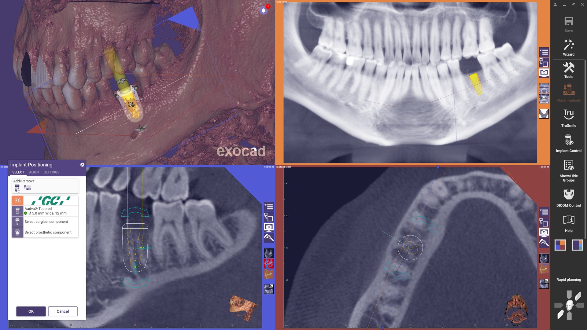 Rozhraní exoplan 3.1 Rijeka při plánování implantátu z DICOM dat