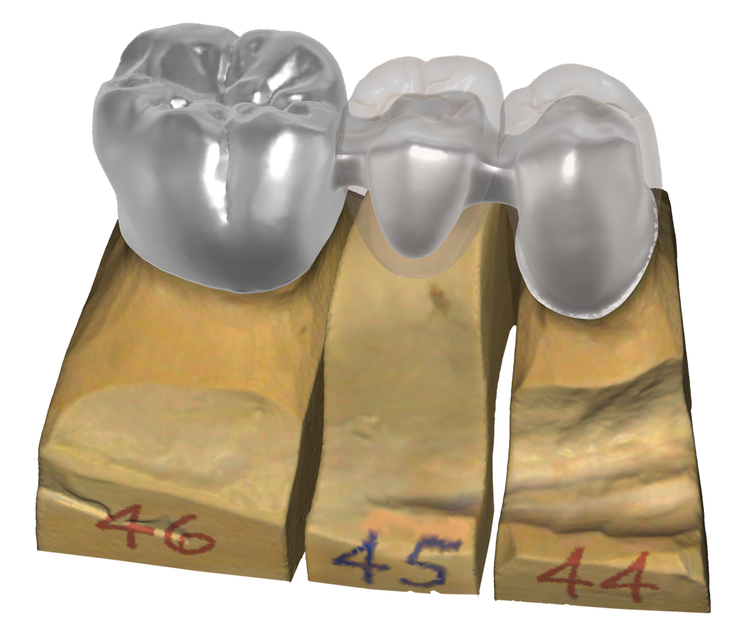 Návrh korunek a můstku v DentalCAD