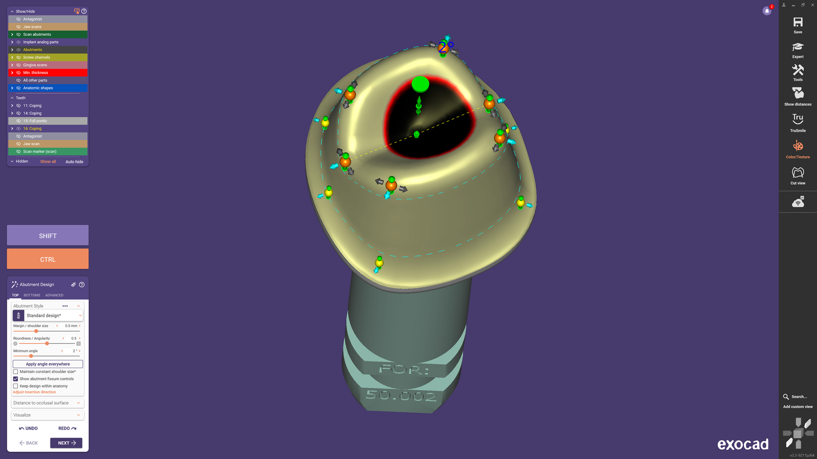 Návrh individuálního abutmentu v Implant Module