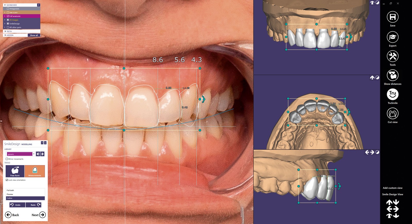 Návrh úsměvu z fotografie a 3D skenu ve Smile Creator